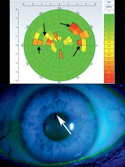 tear film stability test|normal tear film length.